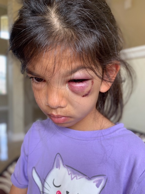 Poor little India with her shiner after being hit in the face with a baseball bat at the Gordon Head Skate Park.